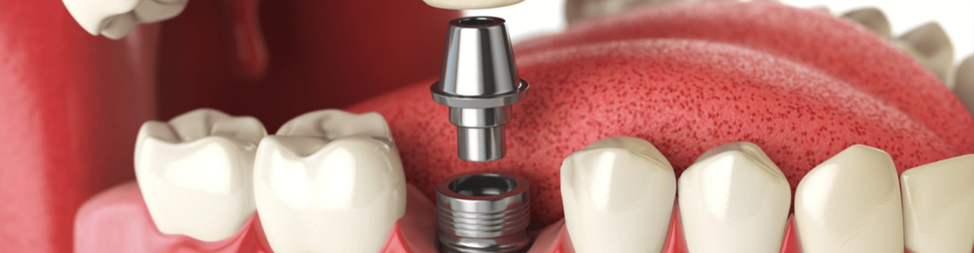 rendering of a dental implant being placed in a mouth